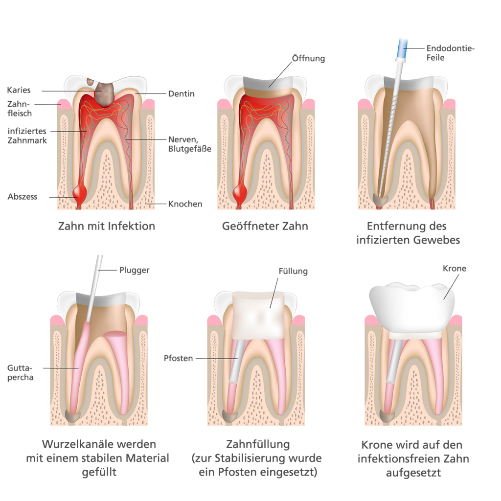 Praxisgemeinschaft Zahnarzte Alstercity Zahne Retten Endodontie